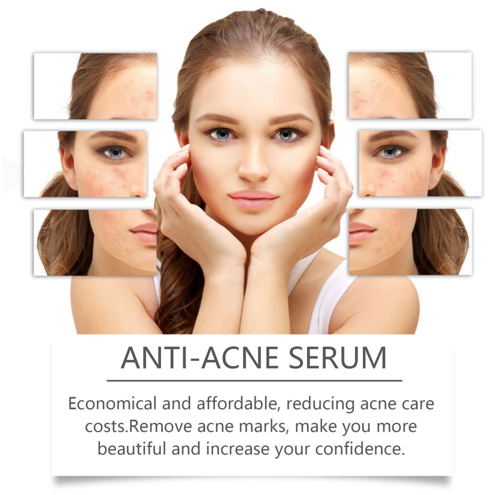 Anti-acne serum — helps remove acne marks for clearer, more confident skin